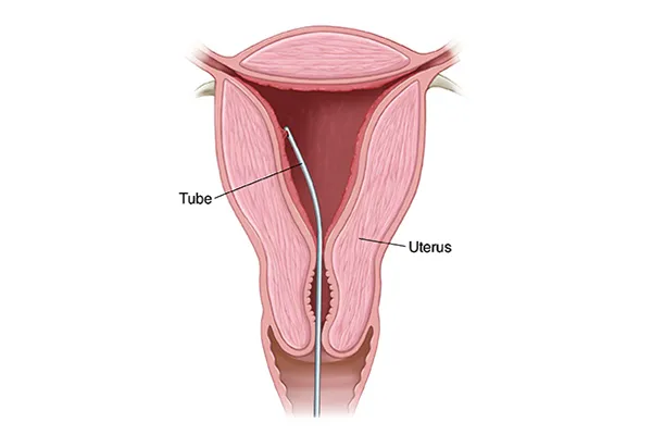 Endometrial Biopsy