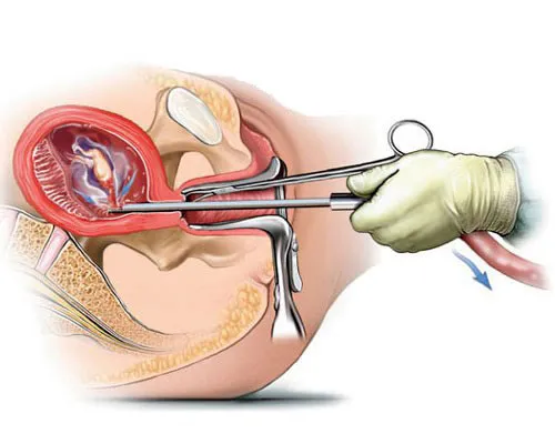 Curettage