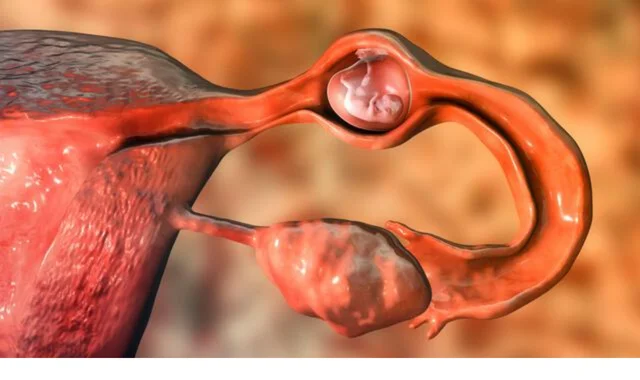 Ectopic Pregnancy (Extrauterine Pregnancy)