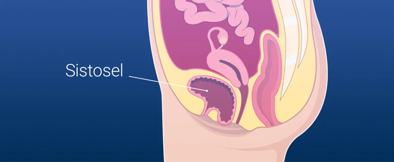 Cystocele (Bladder Prolapse)