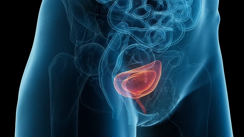 Overactive Bladder