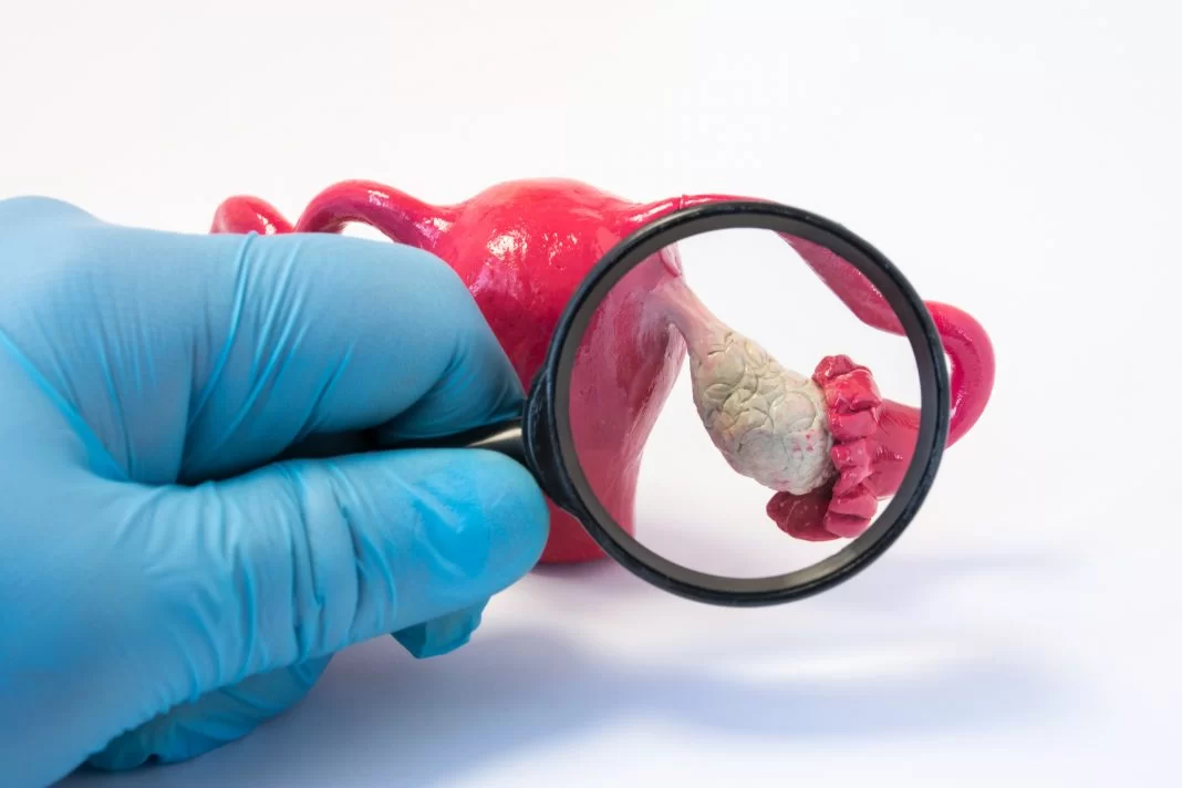 Polycystic Ovary Syndrome (PCOS)