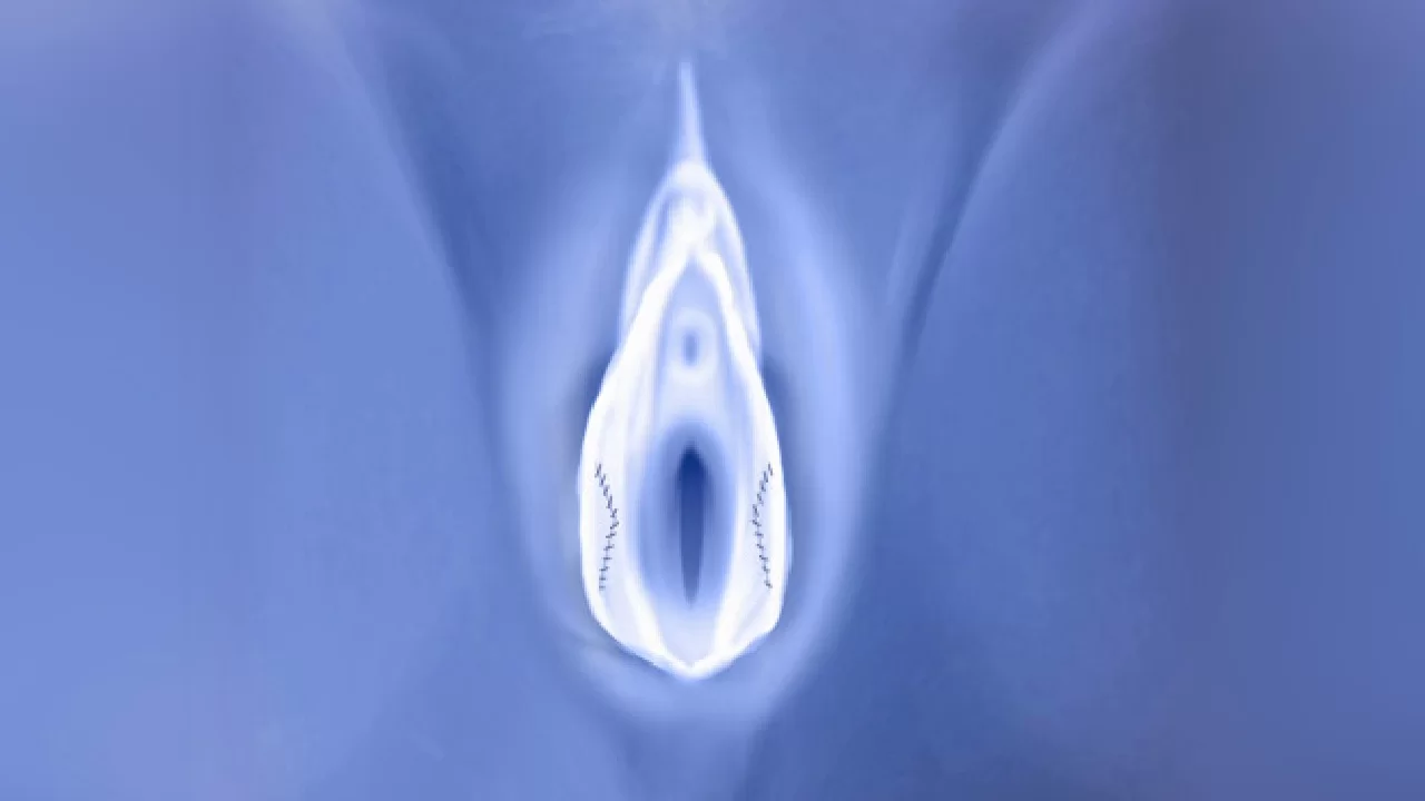 Labiaplasty