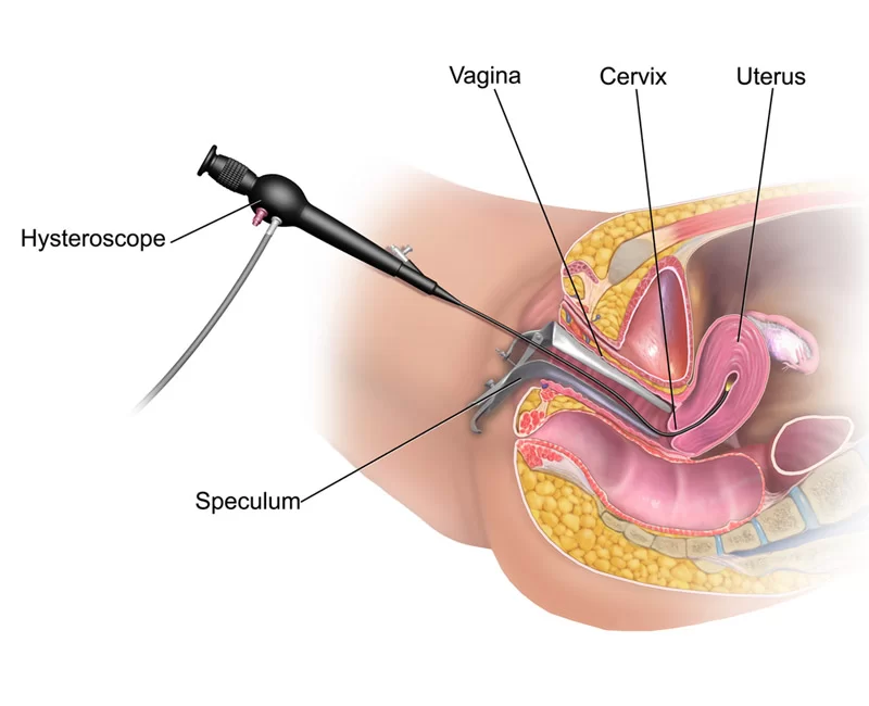 Hysteroscopy