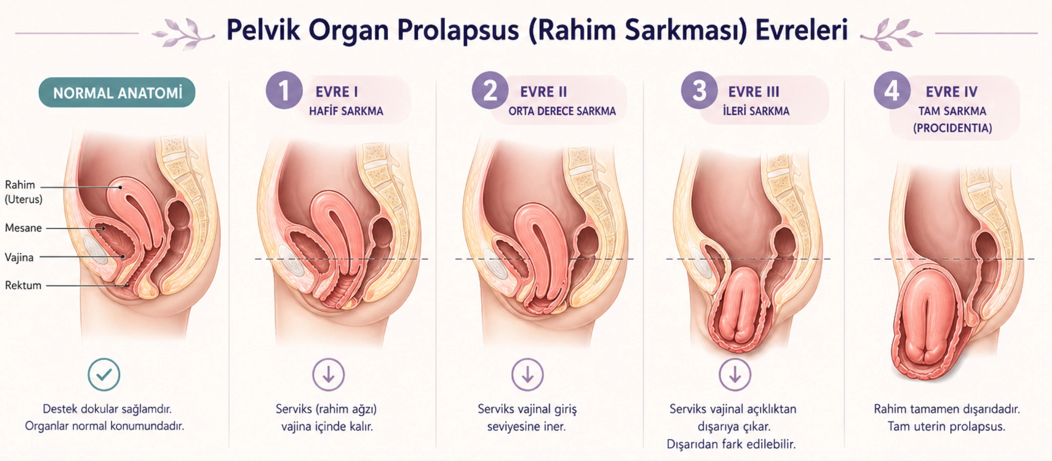 Uterine Prolapse